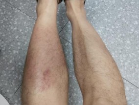 男子蹚水竟染上丹毒！雨天户外行走指南请查收